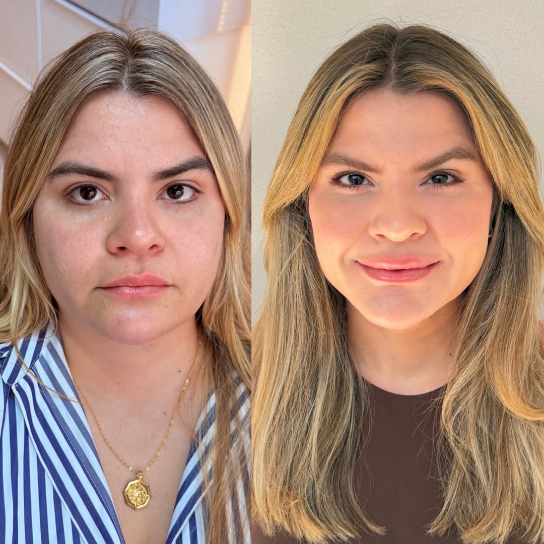Resultado Harmonização Facial — Antes e Depois
